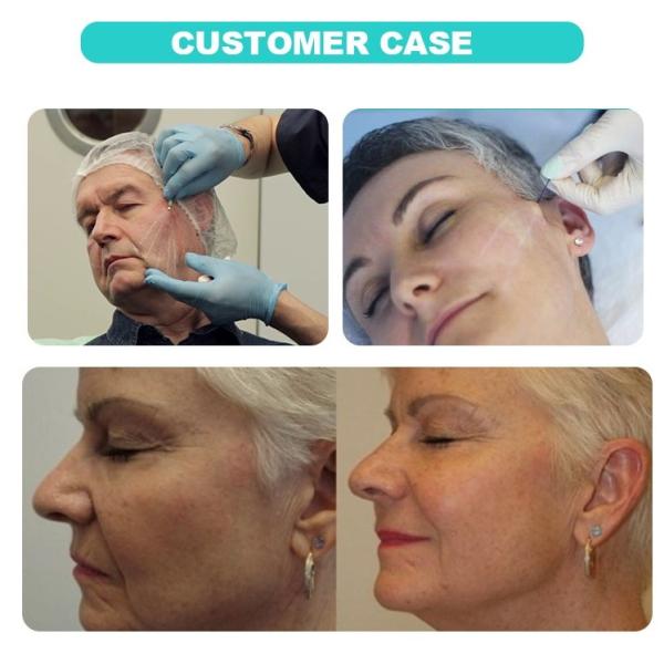 Type A Onabotulinumtoxina Injection