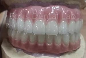 Wholesale Precise Fit Ivoclar Teeth Acrylic Complete Denture Stain Resistant from china suppliers