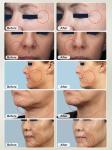 Fractional Rf Microneedle Radio Frequency Skin Tightening Machine