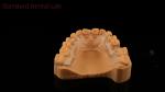 Perfect Fit Germany Ortho Teeth Halley Retainer for Esthetics and Adjustability