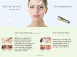 Triangel Laser Optic Fiber 980nm 1470nm Lipolysis Liposuction machine , 1470nm