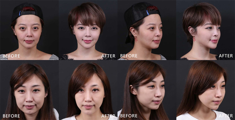 Factory price beauty device hifu portable for skin tightening