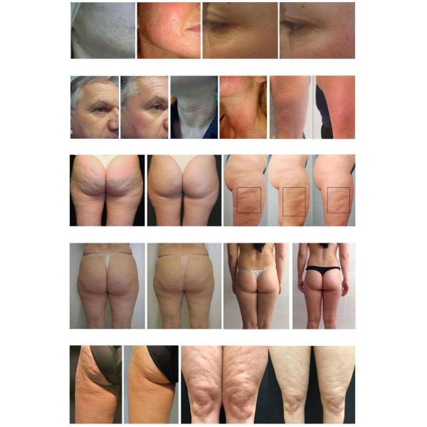 All In One 10D Slimming Roller Laser Equipment With Biolight Technology For Clinics And Spas