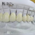 Translucent Layered Zirconia Crown Dental Restoration Multilayer Zirconia Crown