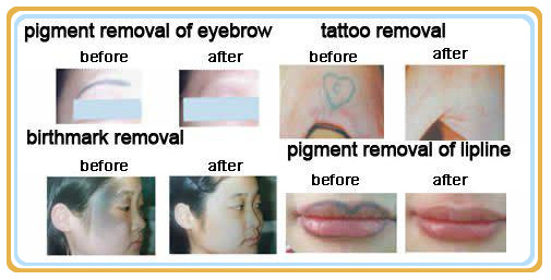 Portable Q - Switched ND Yag Laser , 532nm Professional Laser Tattoo Removal Equipment