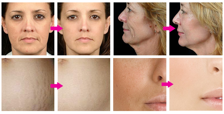Commercial Skin Rejuvenation Beauty Rf Microneedle Rf Machine