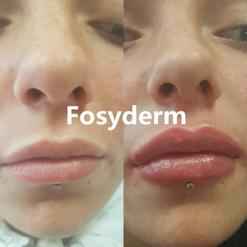 Transparent 1ml Sexy Lips Hyaluronic Acid Derm Line Gel Dermal Lip Fillers
