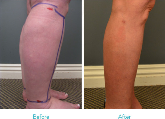 Aesthetics Surgical Liposuction Machine For Calves / Ankles Fat Removal