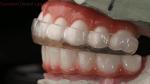 Hard & Soft Night Guard Dental Mouth Guard Hard Soft Night Guard Professional