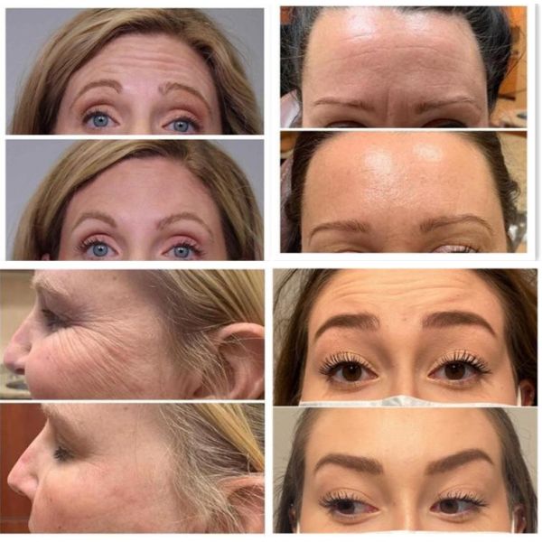 Beauty Products Allergan 100units Botulinum Toxin For Face Wrinkles Dermal Filler
