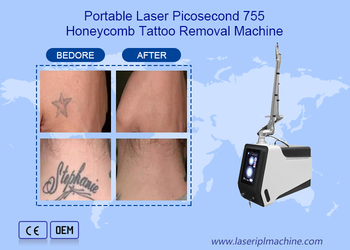 Picosecond Nd Yag Laser Machine For Freckles Removal Eyebrow Removal