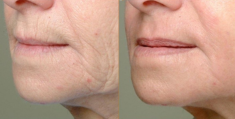 Professional CO2 Fractional Laser Machine For Stretch Marks / Scar Removal
