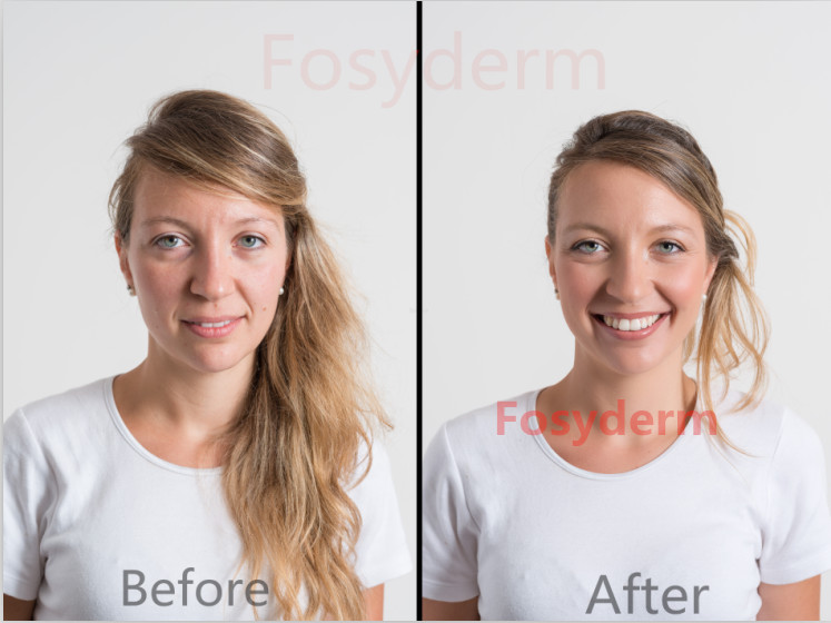 Skin Care HA Cross Linked Dermal Filler For Face Injectable Long Lasting